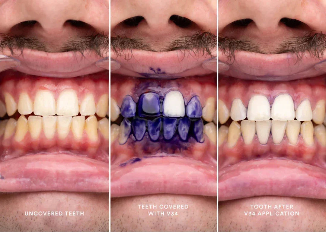 Blanqueamiento dental casero HiSmile®︎🦷🌟
